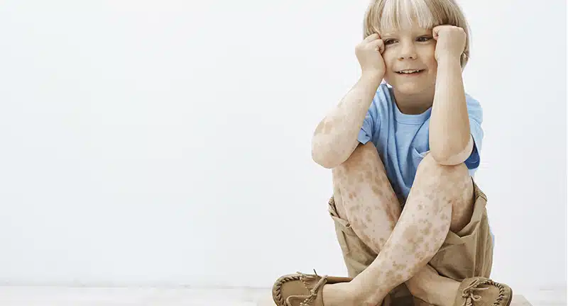What are the causes of vitiligo