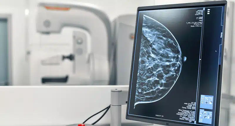 Mamografia cancer de mama y genética - breast cancer and genetics